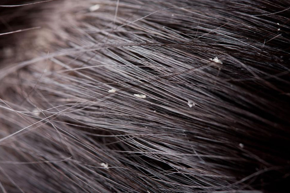 How to Control Dandruff and Flaky Scalp