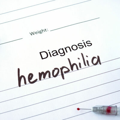 Symptoms and Treatment of Hemophilia