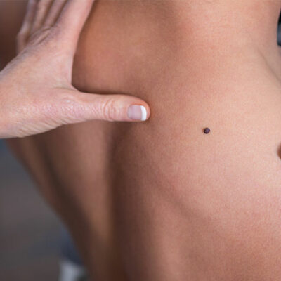 Prevention, Symptoms, and Treatment of Melanoma