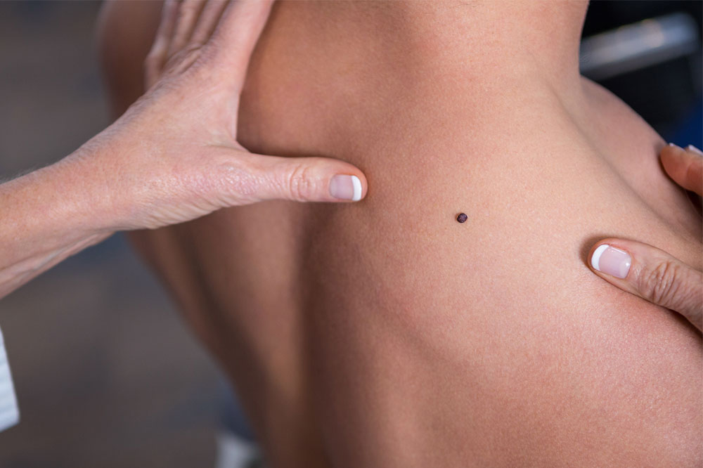 Prevention, Symptoms, and Treatment of Melanoma