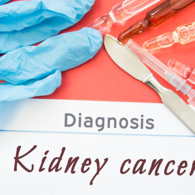 The Stages and Treatment for Kidney Cancer